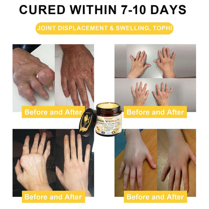 Bee Venom Arthritis Therapy Cream(𝐒𝐩𝐞𝐜𝐢𝐚𝐥𝐢𝐳𝐢𝐧𝐠 𝐢𝐧 𝐨𝐫𝐭𝐡𝐨𝐩𝐞𝐝𝐢𝐜 𝐜𝐨𝐧𝐝𝐢𝐭𝐢𝐨𝐧𝐬 𝐚𝐧𝐝 𝐣𝐨𝐢𝐧𝐭 𝐩𝐚𝐢𝐧 & AAOS recommends)